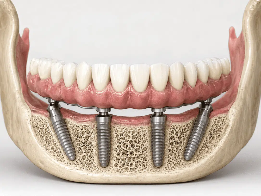 modelo-dental-con-protesis-completa-soportada-por-cuatro-implantes-dentales