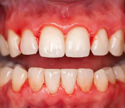 antes-tratamiento.periodontal