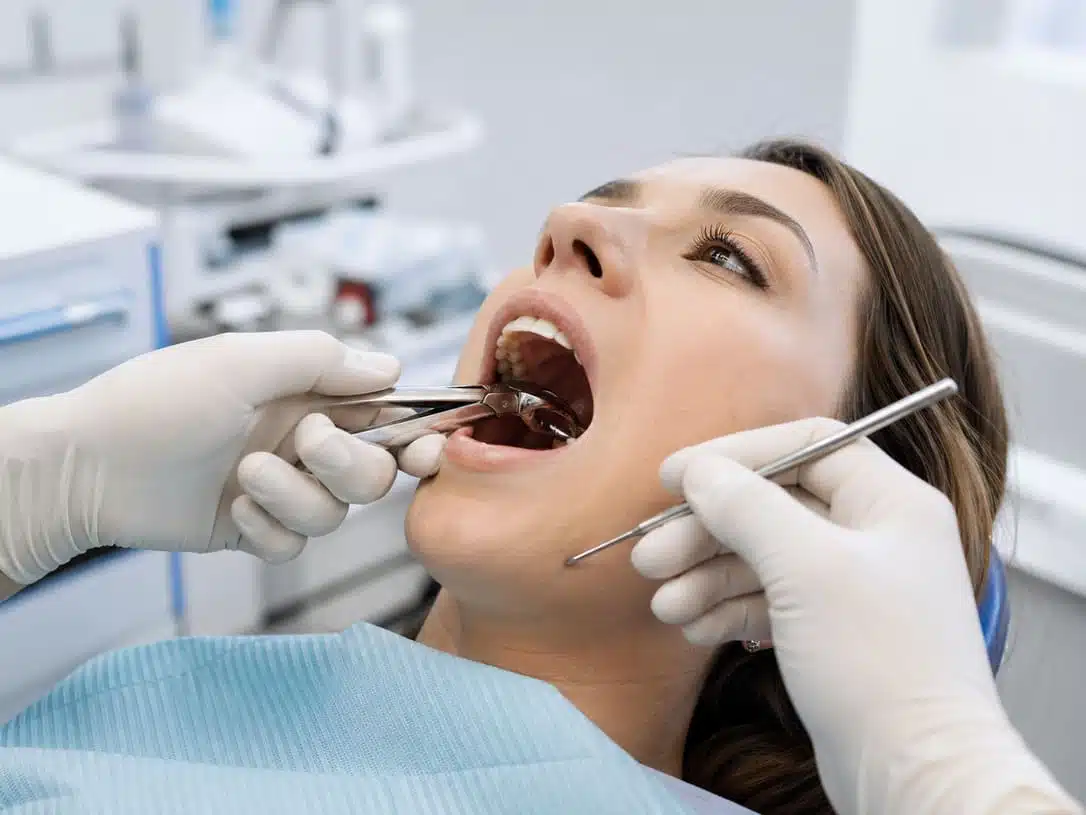 extraccion-muela-del-juicio-procedimiento-odontologico-clinica-dental