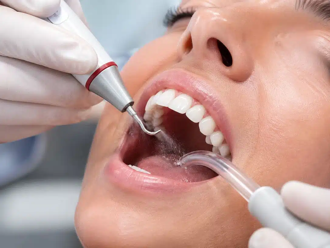 limpieza-dental-ultrasonica-eliminacion-sarro-dentista-procedimiento