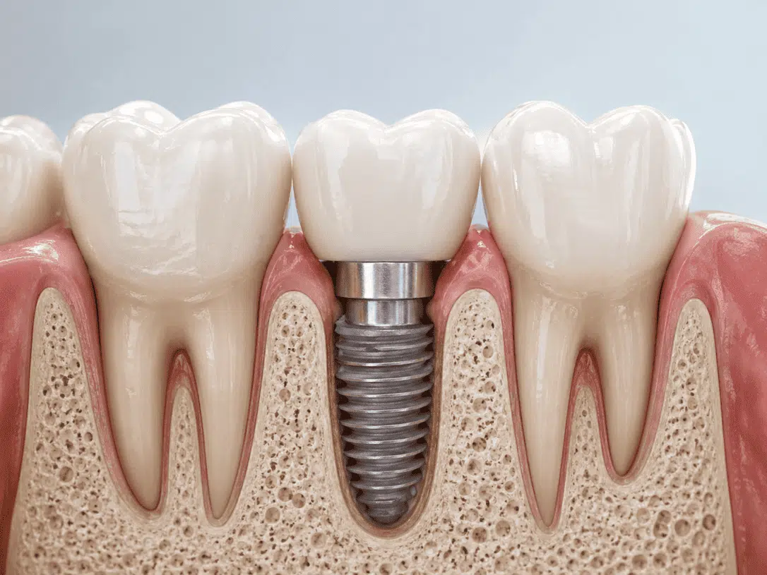 modelo-dental-con-implante-individual-para-reemplazar-un-diente-perdido