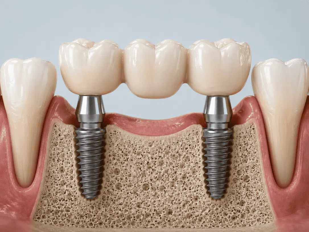 modelo-dental-con-puente-sobre-implantes-para-reemplazar-multiples-dientes