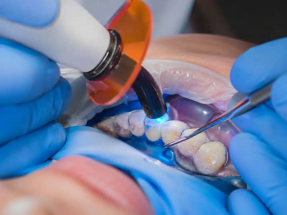 resina-dental-restauracion-caries-curado-luz-led-clinica-dental