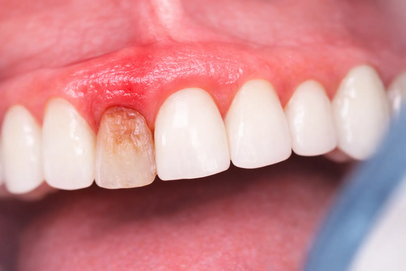 salud-periodontal